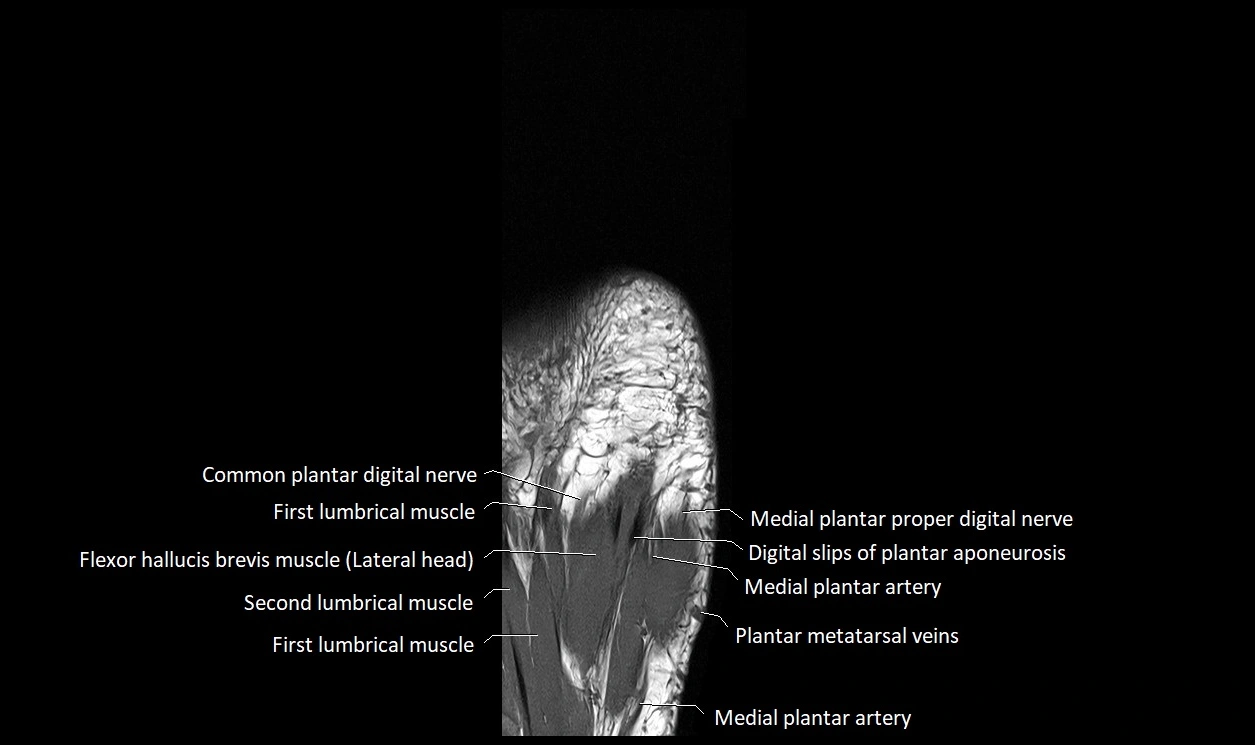 Great Toe micro anatomy MRI axial cross sectional 3T image 25.webp